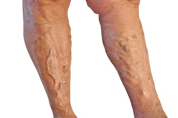 Varicose veins